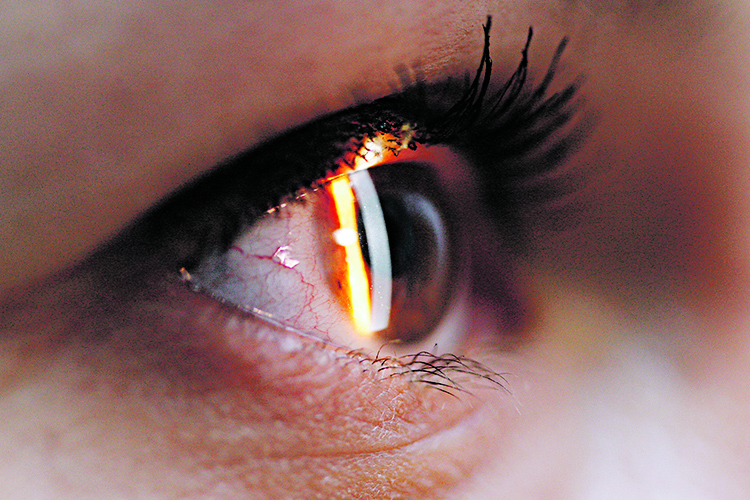 93721-121642-skidanje_dioptrije1-020512