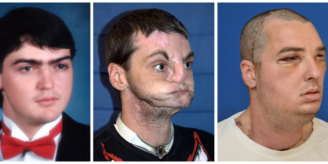 These photographs released March 27, 2012 by the University of Maryland Medical Center show before and after images of full face transplant recipient 37-year-old Richard Lee Norris of Hillsville, Virginia, who was injured in a 1997 gun accident.  The University of Maryland released details March 27, 2012 of the most extensive full face transplant completed to date, including both jaws, teeth, and tongue. The 36-hour operation occurred on March 19-20, 2012 at the R Adams Cowley Shock Trauma Center at the University of Maryland Medical Center and involved a multi-disciplinary team of faculty physicians from the University of Maryland School of Medicine and a team of over 150 nurses and professional staff.    AFP PHOTO / UNIVERSITY OF MARYLAND MEDICAL CENTER    == RESTRICTED TO EDITORIAL USE / MANDATORY CREDIT:  
