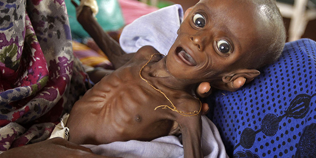 FILE - In this Tuesday, July 26, 2011 file photo, then seven month old Minhaj Gedi Farah is treated in a field hospital of the International Rescue Committee (IRC) in Dadaab, Kenya. In July, Minhaj was one of dozens of limp babies under mosquito net shrouds in the sweltering wards of the IRC hospital in Dadaab, the world's largest refugee camp, but after months of intensive feeding the Somali boy has the chubby cheeks and cheeky smile of most babies his age. (AP Photo/Schalk van Zuydam, File)