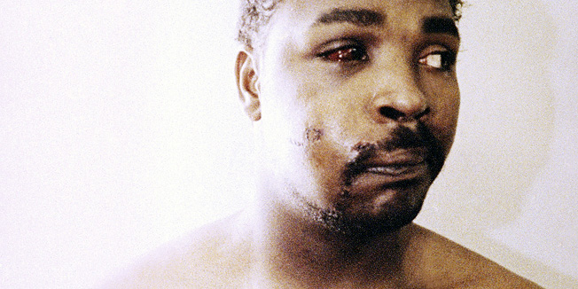 FILE - This file photo of Rodney King was taken three days after his videotaped beating in Los Angeles on March 6, 1991. King, the black motorist whose 1991 videotaped beating by Los Angeles police officers was the touchstone for one of the most destructive race riots in the nation's history, has died, his publicist said Sunday, June 17, 2012. He was 47. (AP Photo/Pool, File)