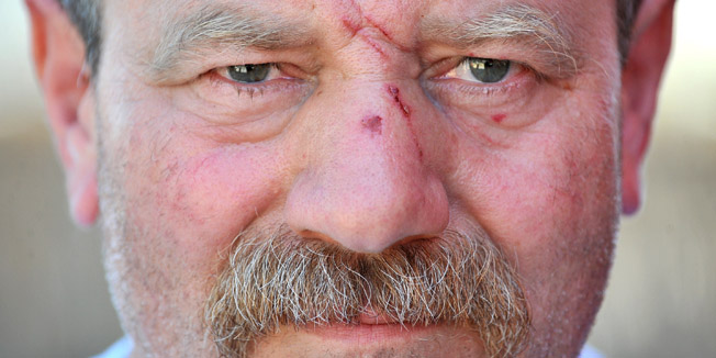 Zadar, 020713Goran Perovic Mungos koji je prekjucer napadnut na zadarskoj trznici jer je radio sa fiskalnom blagajnom dok su prodavaci strajkali u znak prosvjeda protiv uvodjenja istih.Luka Gerlanc / CROPIX