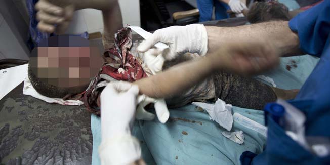 A wounded Palestinian boy is treated by medics at the al-Shifa hospital in Gaza City on July 9, 2014 following an Israeli air strike. Eleven Palestinians were killed in a series of Israeli air strikes on Gaza today, hiking the overall death toll to 32 in two days, with more than 150 wounded, medics said.  AFP PHOTO / MOHAMMED ABED