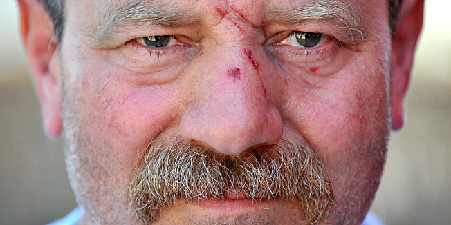 Zadar, 020713Goran Perovic Mungos koji je prekjucer napadnut na zadarskoj trznici jer je radio sa fiskalnom blagajnom dok su prodavaci strajkali u znak prosvjeda protiv uvodjenja istih.Luka Gerlanc / CROPIX