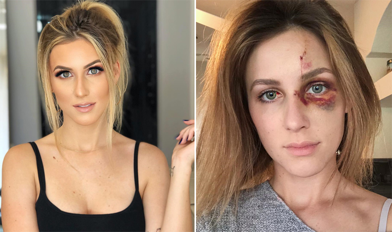 Lijevo: fotografija koja je navodno isprovocirala Melissinog dečka, desno: ozljede koje je Melissi nanio njezin dečko