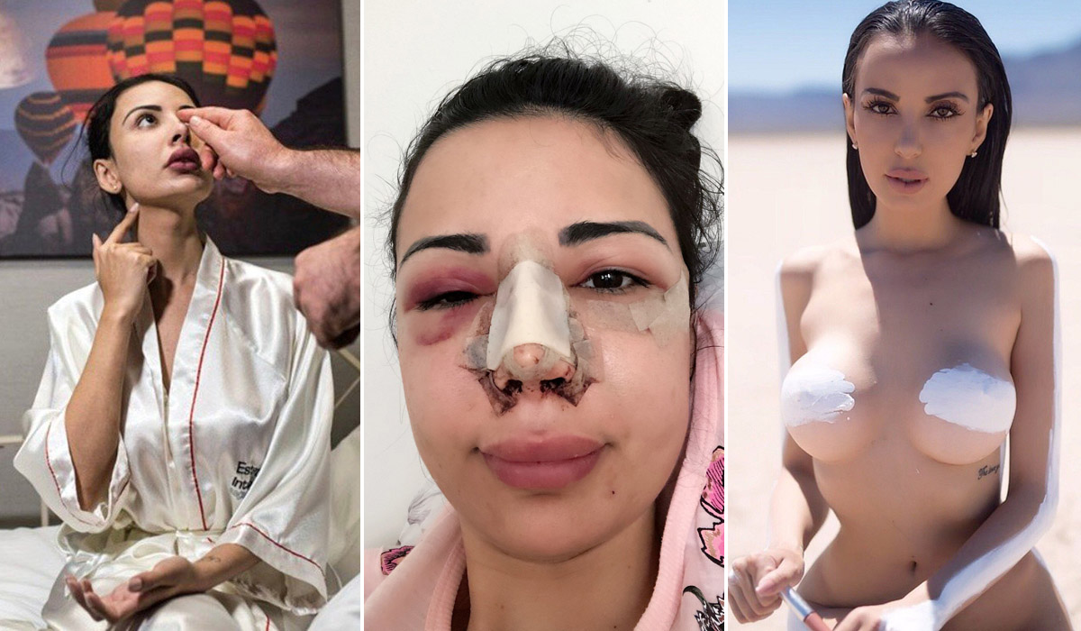 Jennifer Pamplona (25) iz Brazila ide na estetske operacije kako bi što više ličila na američku reality zvijezdu Kim Kardashian. Zadnje u nizu bila je operacija nosa i obraza