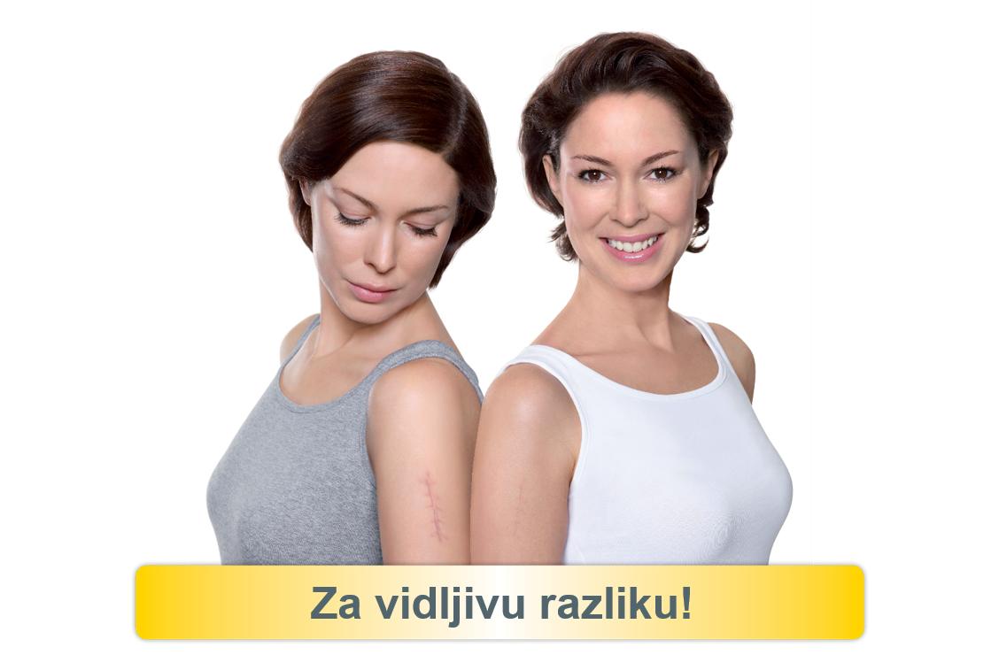 Ovaj gel možete koristiti za nove, ali i za tretiranje starih ožiljaka.