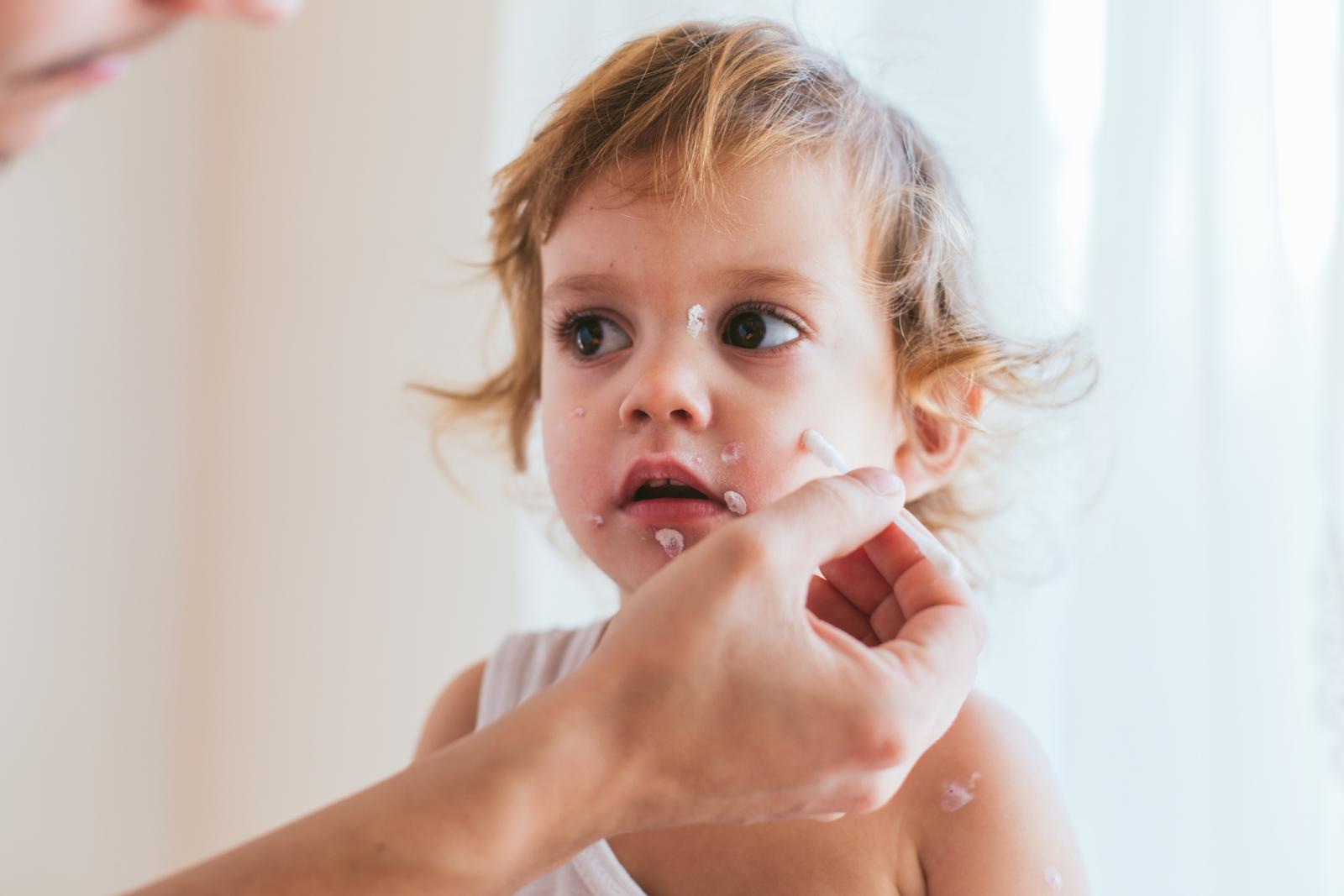 Kako bismo izbjegli infekciju kože najbolje je koristiti gel ili sprej s efektom hlađenja.