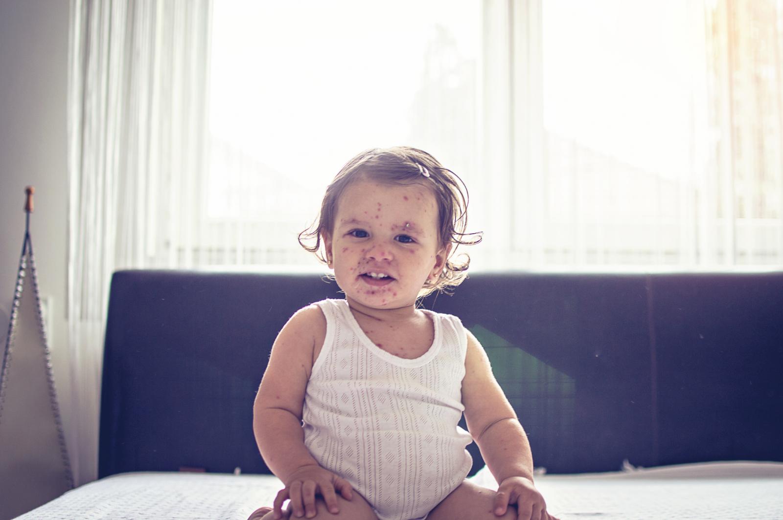 Ospice su visoko kontagiozna virusna infekcija koja se najčešće pojavljuje u dječjoj dobi. 