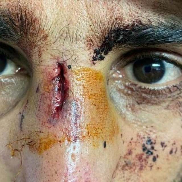 Azilant koji tvrdi da ga je napala Hrvatska policija