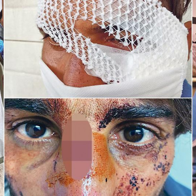 Ozlijeđeni migranti