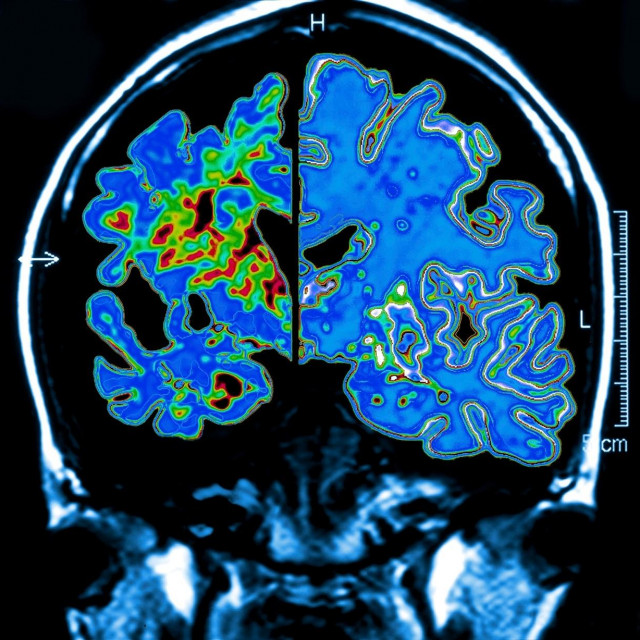 Alzheimerova bolest, Ilustracija