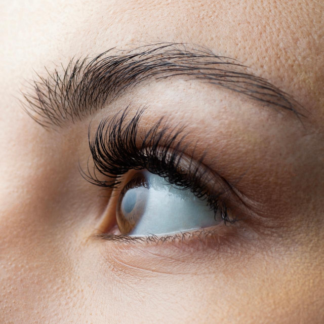 Nakon reza radiofrekventnim nožem ožiljka na koži donje vjeđe nema
