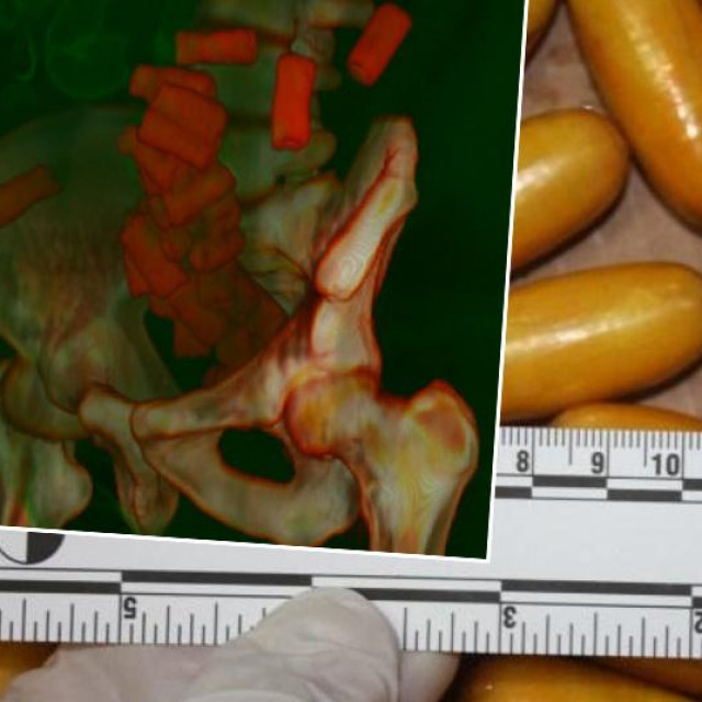 Rendgen snimka tijela krijumčara droge koji u želucu prenosi kapsule kokaina i droga pronađena u tijelu Brazilke u Zračnoj luci Franjo Tuđman