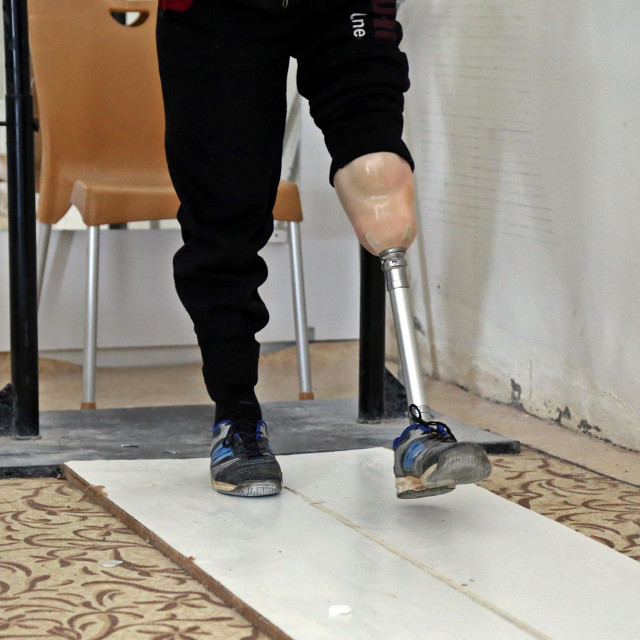 Proteza, ilustrativna fotografija
