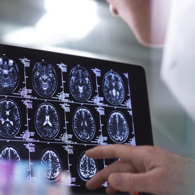 Snimka mozga; ilustracija
