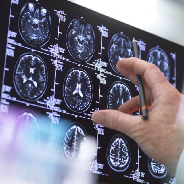 Skeniranje mozga; ilustracija
