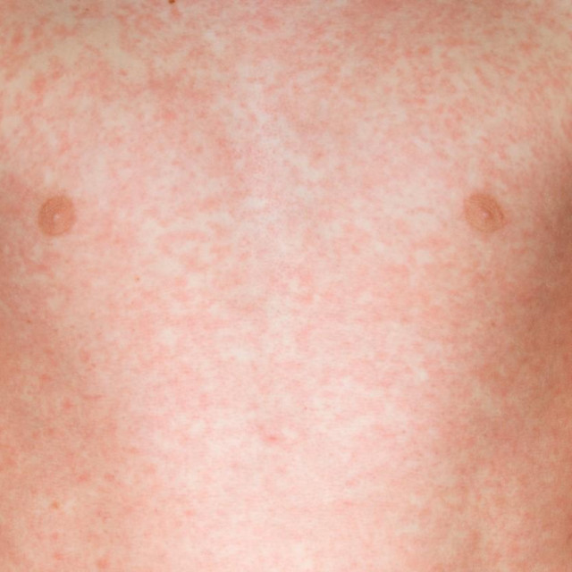 Ospice na desetogodišnjaku/Ilustracija
