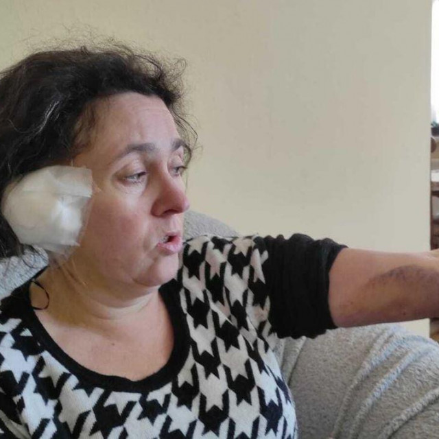 Angelika Maria Brezić u napadu psa lutalice ostala je bez 2/3 desnog uha
