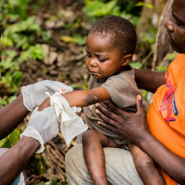 Dijete zaraženo Majmunskim boginjama