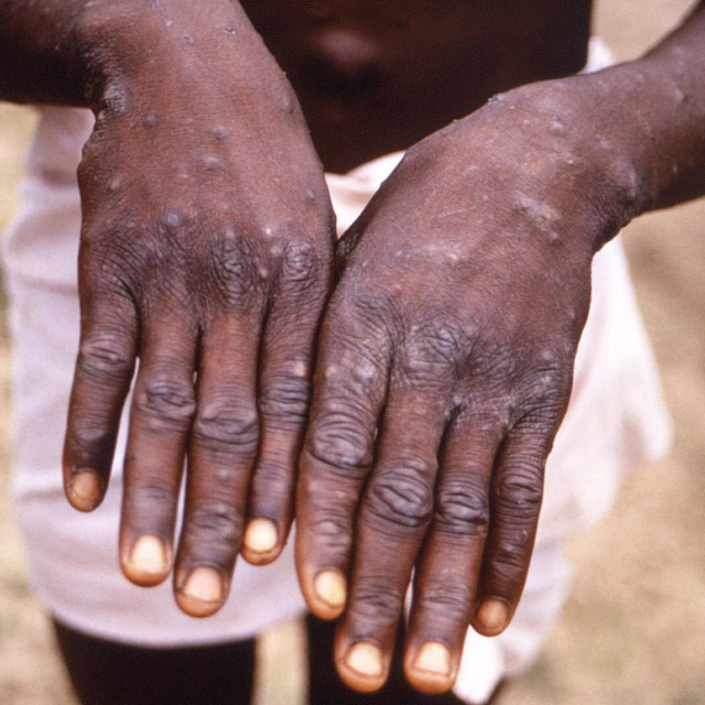 ECDC je ukazao na važnost što brže potvrde novih slučajeva bolesti