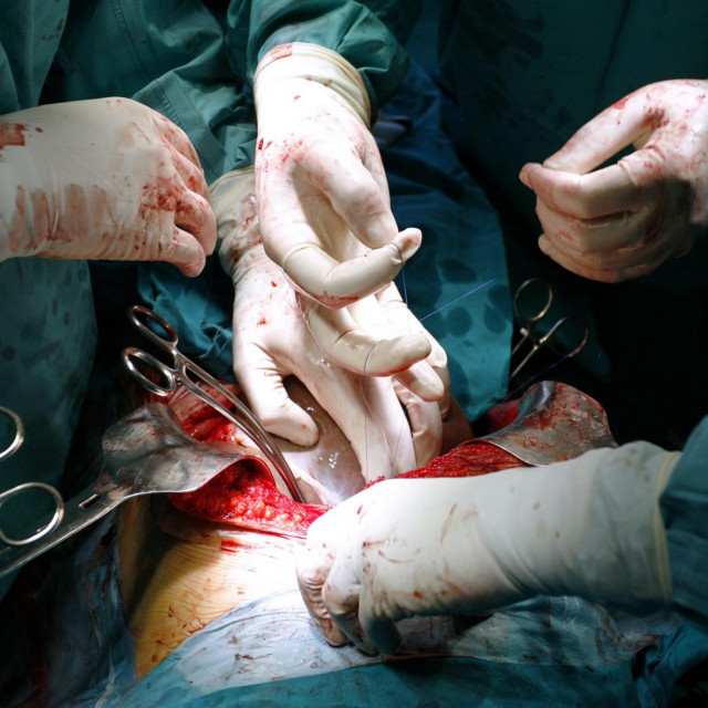 Transplantacija organa (Ilustracija)