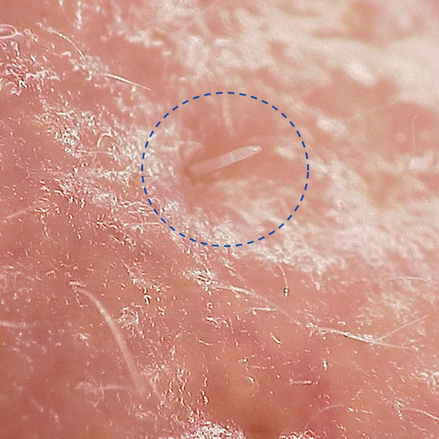 Demodex folliculorum