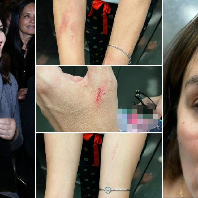 Marijana Vučković-Popović, ozljede na rukama Severine i Severina