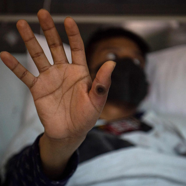 Oboljeli od majmunskih boginja