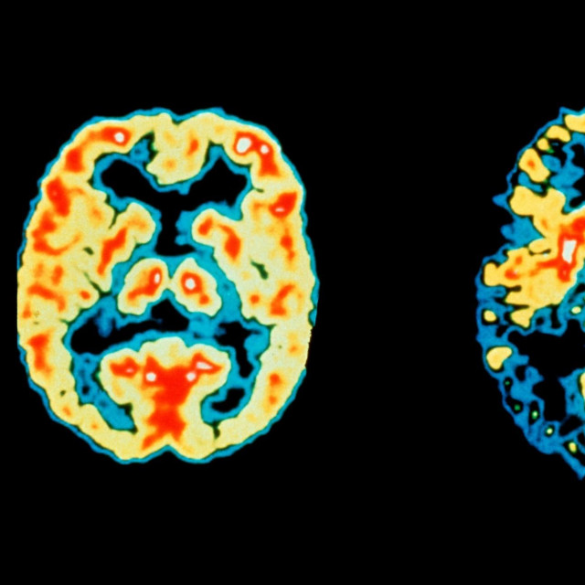 Alzheimeova bolest, Ilustracija