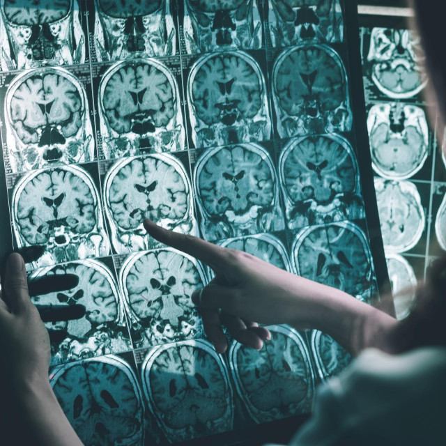 alzheimer‘s disease on MRI