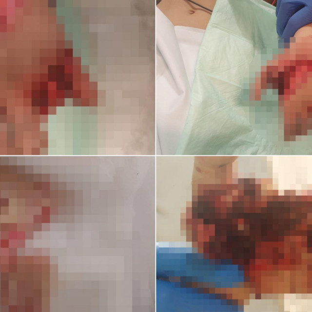 Dječak stradao od petarde