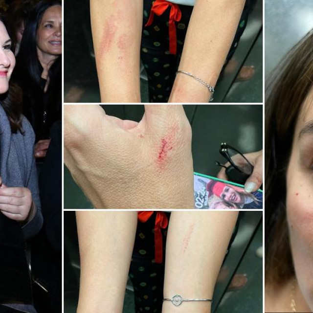 Marijana Vučković-Popović i ozljede na rukama Severine