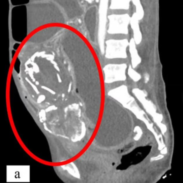 Kalcificirani fetus