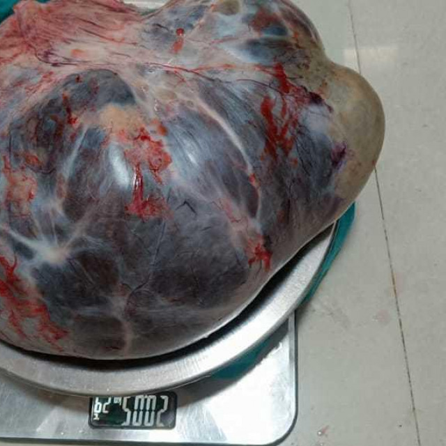 Tumor od 20 kilograma