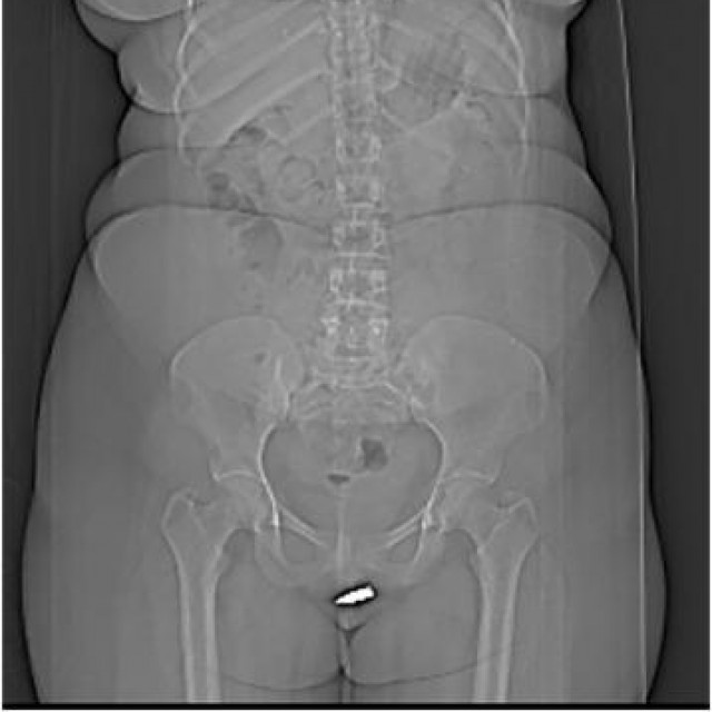 Zalutali metak u klitorisu žene iz Somalije