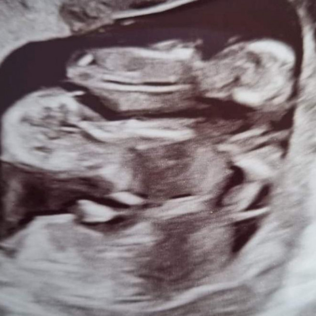 Ultrazvuk Jenni Casper