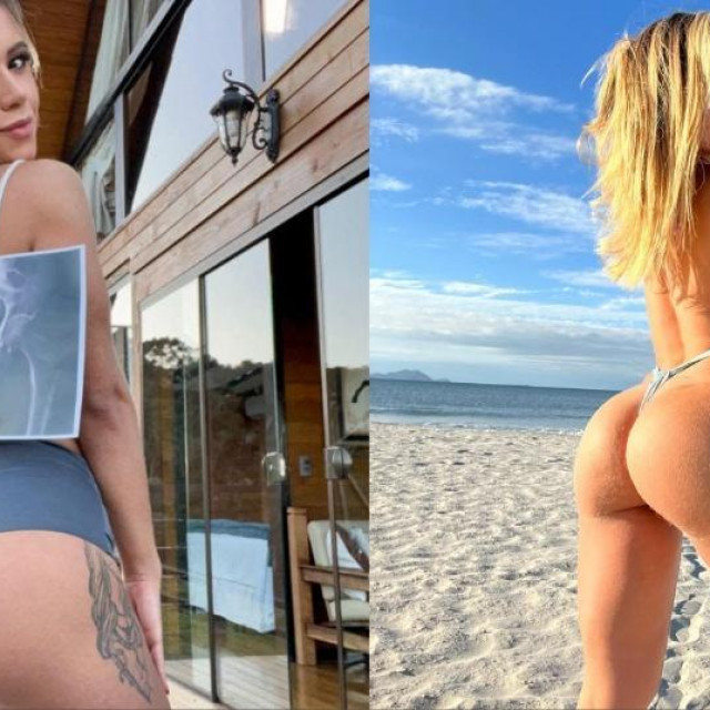 Larissa Sumpani s rengenskom snimkom svoje stražnjice (lijevo)