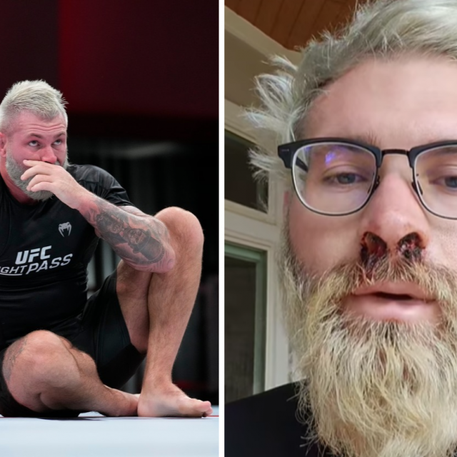 Gordon Ryan (desno je fotografija nakon operacije devijacije septuma)