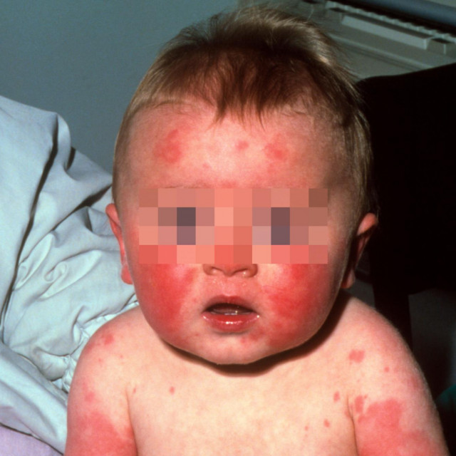 Peta bolest/Ilustracija