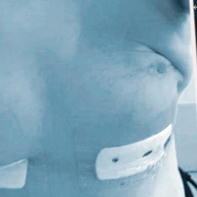 Zagrepčanka (37) koju je unakazio kirurg