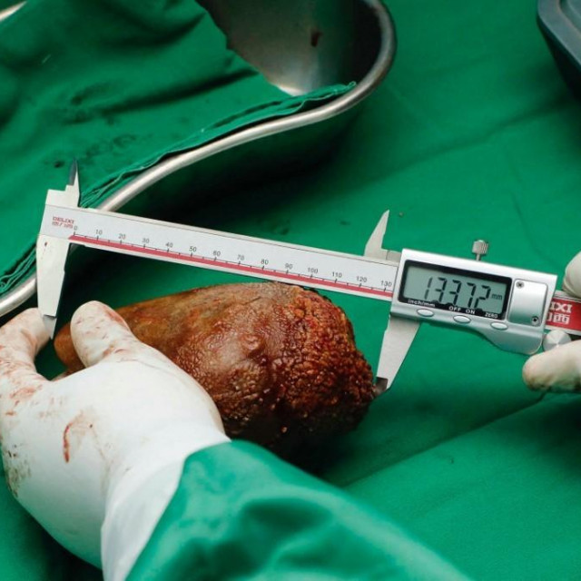 Fotografija bubrežnog kamenca koju je objavila vojska Šri Lanke