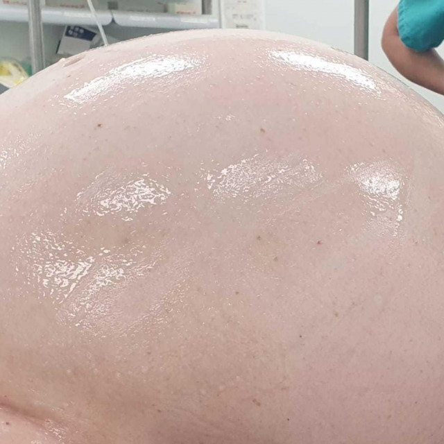 Tumor koji su izvadili pacijentici u Gospiću