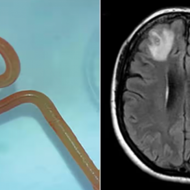 Crv izvađen iz tijela nesretne Australke, koja je do operacije prošla pravi pakao