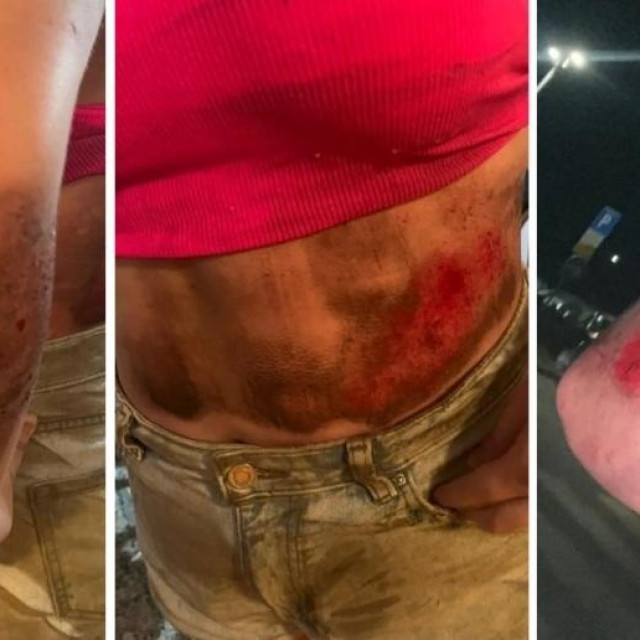 Ozljede djevojke koju je vukao ZET-ov autobus