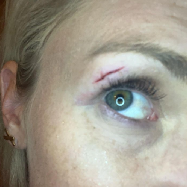 Paula Jeričević Tonković ozlijedila oko na svadbi