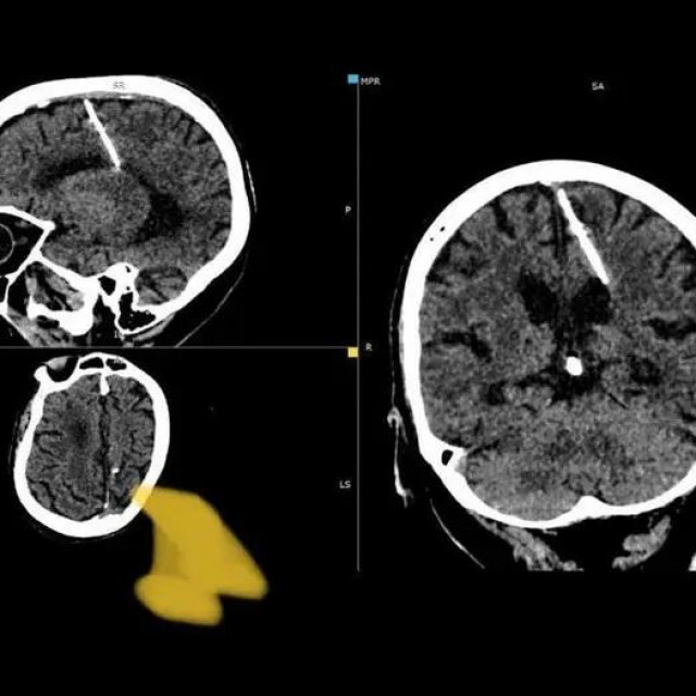 Igla u mozgu žene u Rusiji