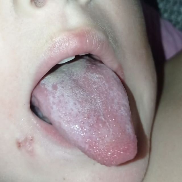 Jezik dječaka koji je popio odmašćival