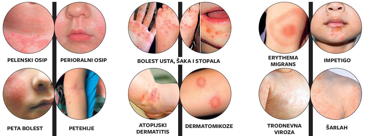 ivim - Naa pedijatrica donosi totalni vodi kroz djeje osipe: ova  infografika e vas spasiti!