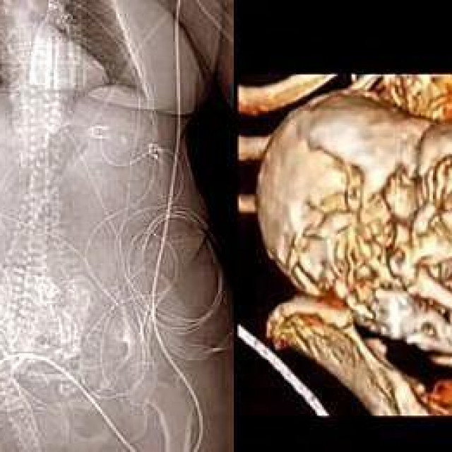 Rijetki fenomen ‘kamene bebe‘