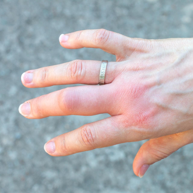 Reakcija na ubod ose